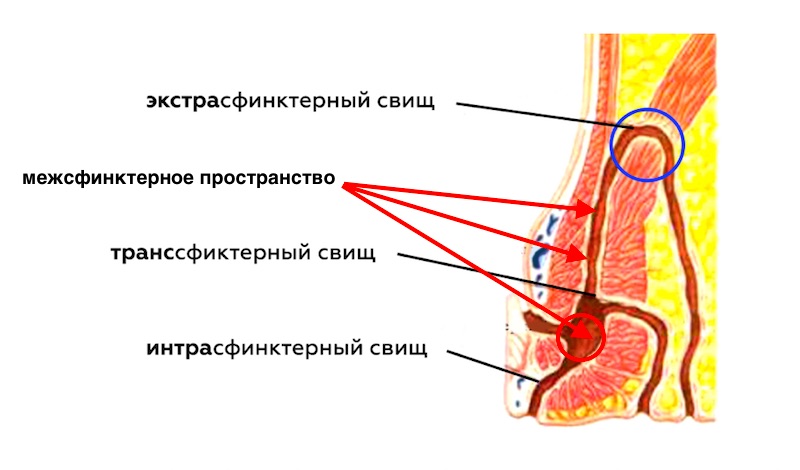 Проведение лигатур при экстрасфинктерном свище прямой кишки.